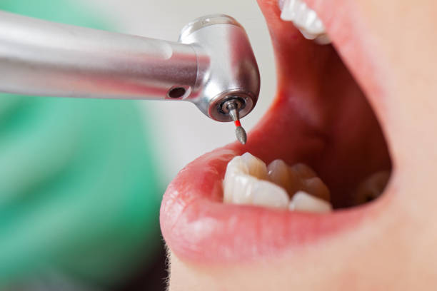 Best Emergency Wisdom Teeth Removal in Port Angeles, WA